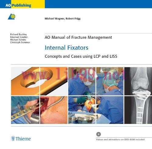 [PDF]AO Manual of Fracture Management - Internal Fixators (包含视频)