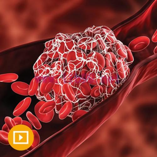 [AME]Thrombosis & Thromboembolism 2022 (CME VIDEOS)