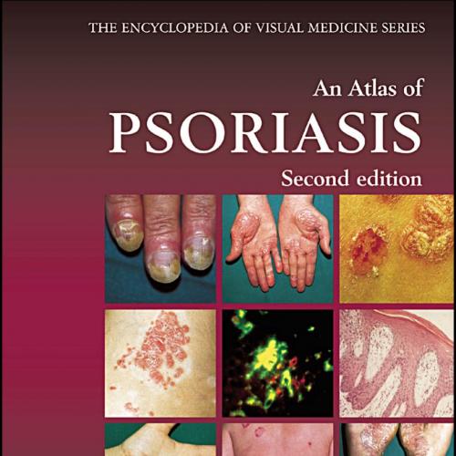 Atlas of Psoriasis, Second Edition (Encyclopedia of Visual Medicine Series), An - Lionel Fry
