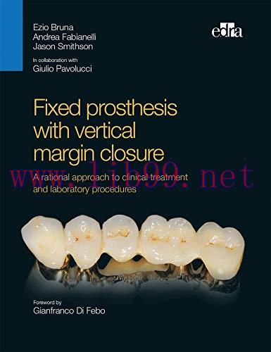 [AME]Fixed prosthesis with vertical margin closure. A rational approach to clinical treatment a...