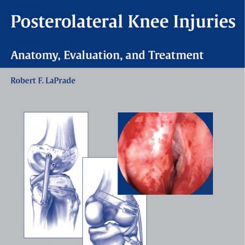 Posterolateral Knee Injuries Anatomy, Evaluation, and Treatment