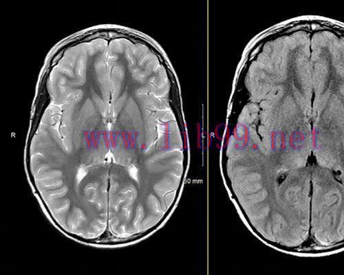 [AME]MRIOnline Mastery Series: Neurofibromatosis Type 1 (NF1) 2021 (CME VIDEOS)