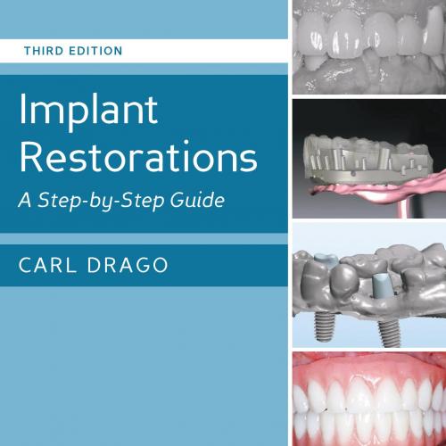 Implant Restorations A Step-by-Step Guide, 3rd Edition