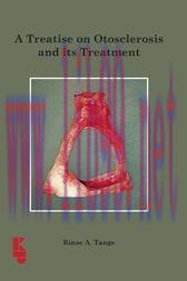 [AME]A Treatise on Otoslerosis and its Treatment (EPUB)