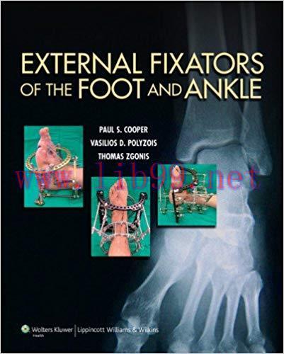 [PDF]External Fixators of the Foot and Ankle +CHM版