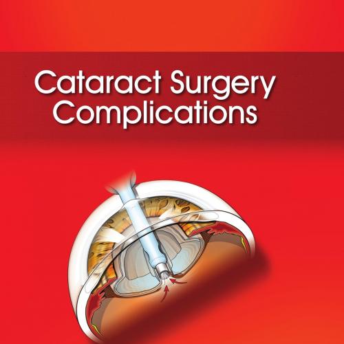 Cataract Surgery Complications
