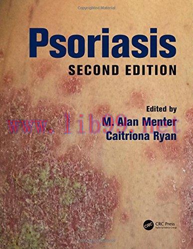 [AME]Psoriasis, Second Edition (EPUB)