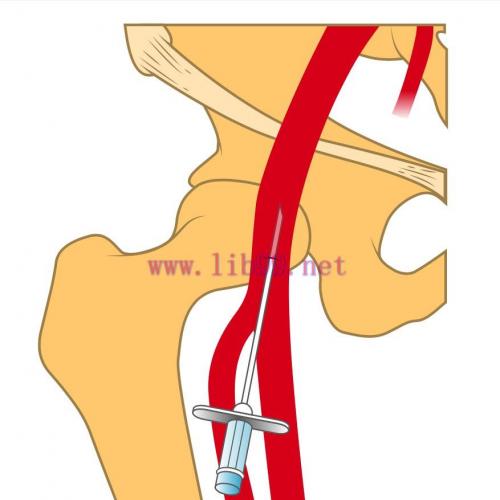 [AME]MRIOnline Imaging Mastery Series: Arterial Access - Principles, Pearls, Pitfalls, and Comp...