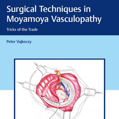 Surgical Techniques in Moyamoya Vasculopathy Tricks of the Trade