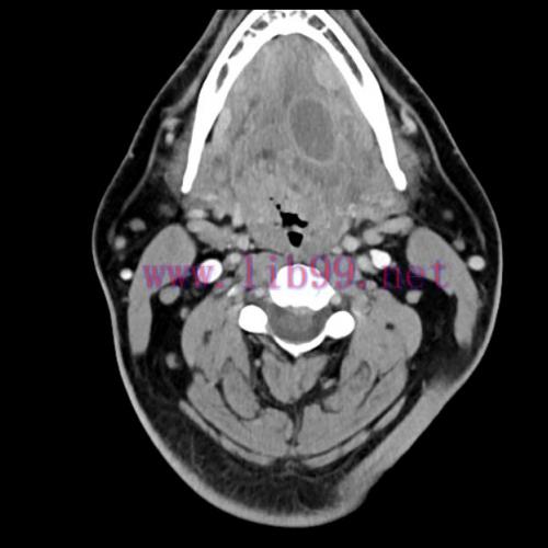 [AME]MRIOnline Imaging Mastery Series: Pathology of the Oral Cavity and Oropharynx 2020 (CME VI...