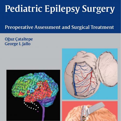 Pediatric Epilepsy Surgery-Preoperative Assessment and Surgical Treatment