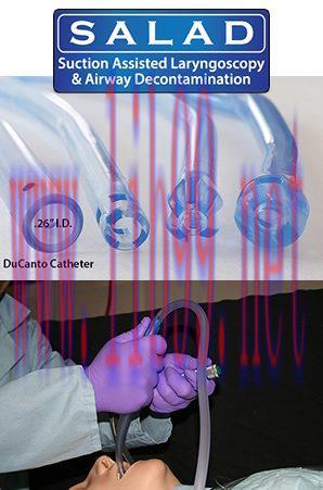 [AME]The SALAD Technique Suction-Assisted Laryngoscopy (with simultaneous) Airway Decontaminati...