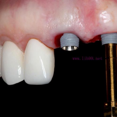 [AME]Online Residency Program: A-Z in Implant Dentistry 2021 (CME VIDEOS)