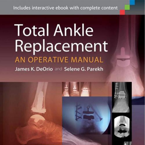 Total Ankle Replacement _ An Operative Manual