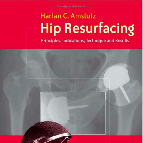 Hip Resurfacing Principles, Indications, Technique and Results Book