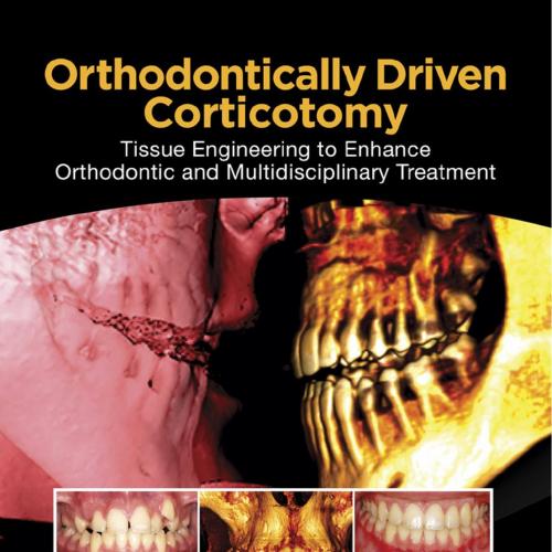 Orthodontically Driven Corticotomy