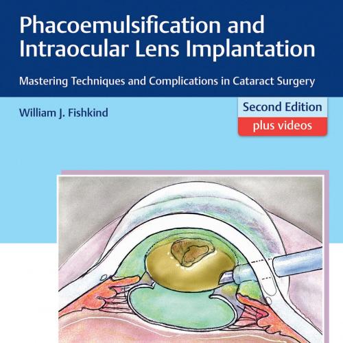 Phacoemulsification and Intraocular Lens Implantation 2nd Edition