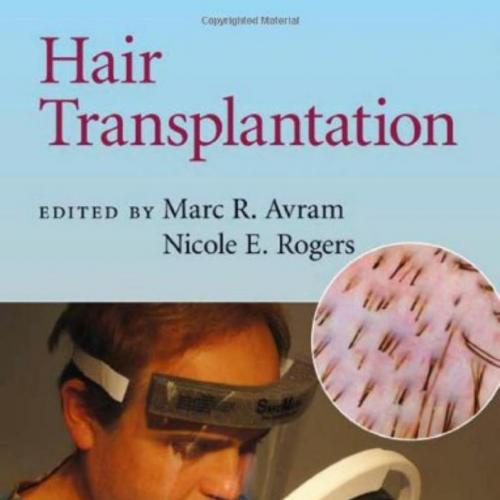 Hair Transplantation (Cambridge Medicine)