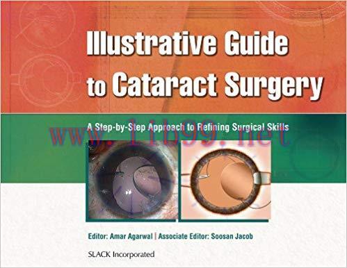 [PDF]Illustrative Guide to Cataract Surgery A Step-by-Step Approach