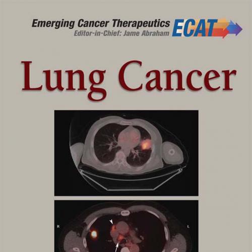 Lung Cancer (Emerging Cancer Therapeutics V3 I1) - Jame Abraham & MD & FACP