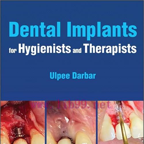 [PDF]Dental Implants for Hygienists and Therapists