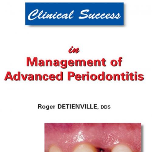 Management of Advanced Periodontitis