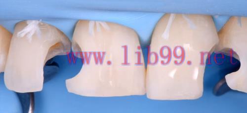 [AME]Gidedental Direct and Indirect Adhesive Restorations &ndash; Minimal Invasive Treatment of the A...