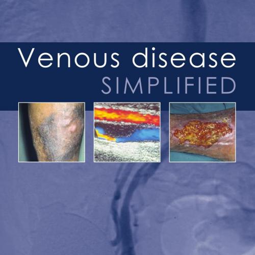 Venous disease SIMPLIFIED - Edited by Alun H Davies, Tim A Lees & Ian F Lane