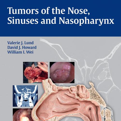 Tumors of the Nose, Sinuses and Nasopharynx - Lund, Valerie J.,Howard, David J_