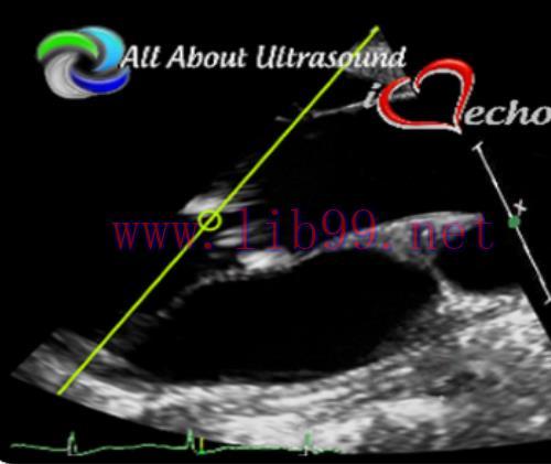 [AME]Mastering Aortic Stenosis - AllAboutUltrasound 2022 (Complete HTML)