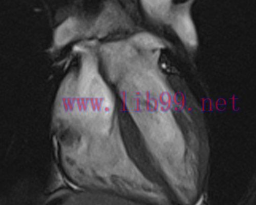 [AME]MRIOnline Mastery Series: Cardiac MRI of Non-Ischemic Cardiomyopathy 2021 (CME VIDEOS)