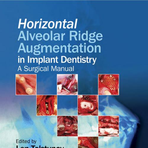 Horizontal Alveolar Ridge Augmentation in Implant Dentistry - A _nodrm