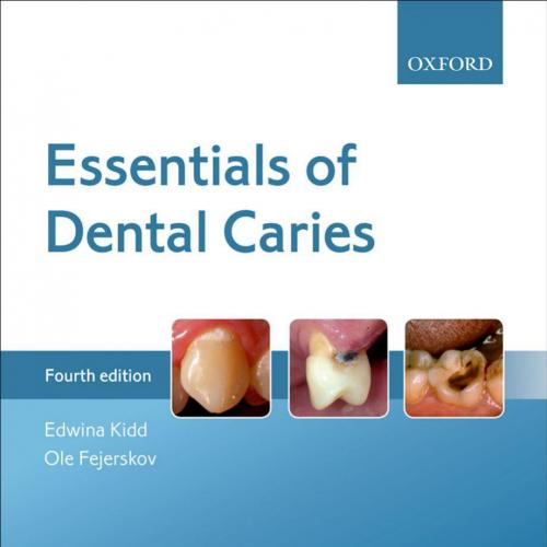 Essentials of Dental Caries_nodrm