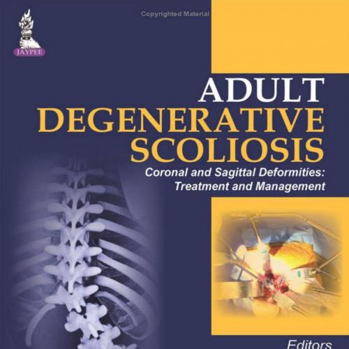 Adult Degenerative Scoliosis-Coronal and Sagittal Deformities Treatment and Management - Wei Zh...