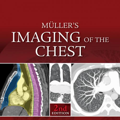 Muller's Imaging of the Chest Expert Radiology Series 2nd