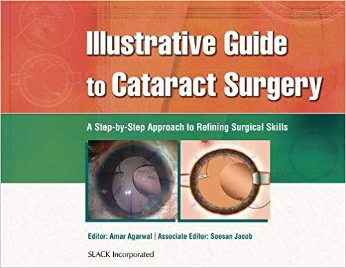Illustrative Guide to Cataract Surgery A Step-by-Step Approach