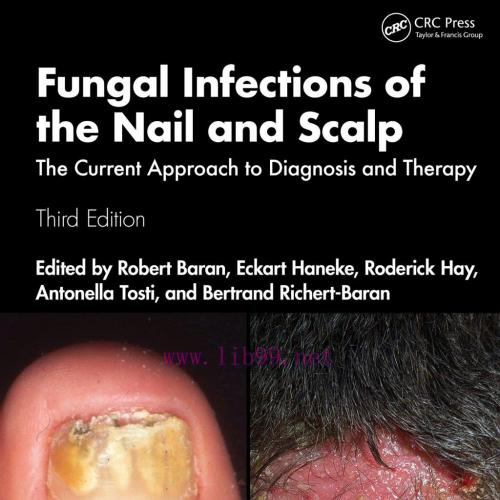 [AME]Fungal Infections of the Nail and Scalp: The Current Approach to Diagnosis and Therapy, 3r...