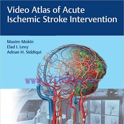 [PDF]Video Atlas of Acute Ischemic Stroke Intervention