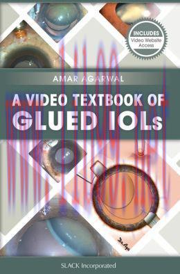 [AME]A Video Textbook of Glued IOLs