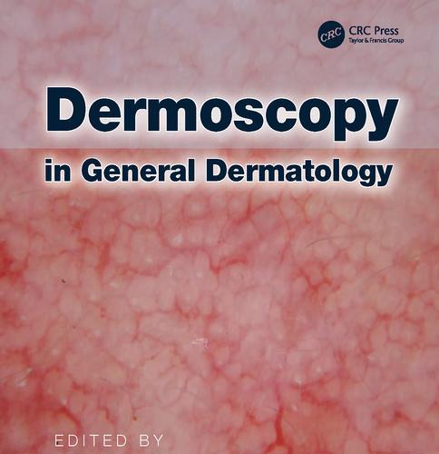 Dermoscopy in General Dermatology