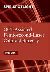 OCT-Assisted Femtosecond Laser Cataract Surgery