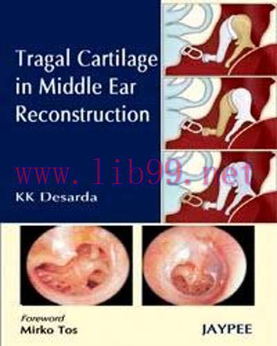 [AME]Tragal Cartilage in Middle Ear Reconstruction (Converted PDF)