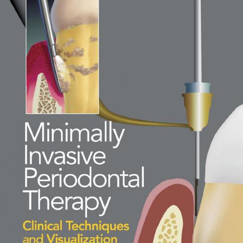 Minimally Invasive Periodontal Therapy - Clinical Techniques and Visualization Technology, 1E (...