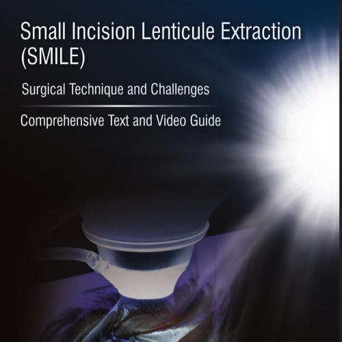 Small Incision Lenticule Extraction (SMILE) Surgical Technique and Challenges by Jeewan S Titiy...