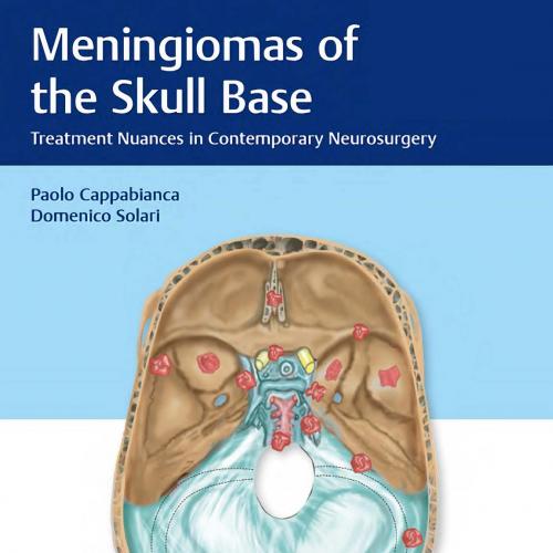 Meningiomas of the Skull Base Treatment Nuances - Wei Zhi