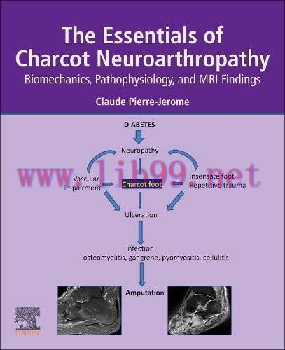 The Essentials of Charcot Neuroarthropathy: Biomechanics, Pathophysiology, and MRI Findings (Or...