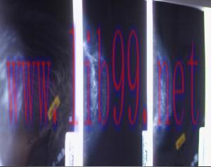 [AME]Breast Biopsy - Ultrasound, Stereotaxis & MRI Guidance 2013 (CME Videos)