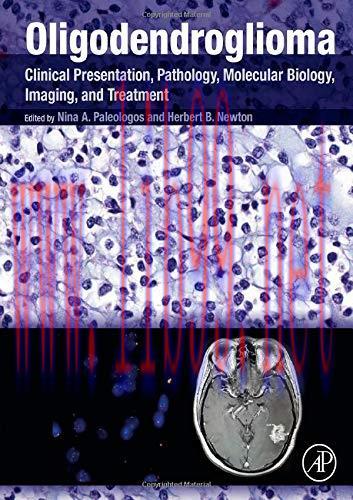 [AME]Oligodendroglioma: Clinical Presentation, Pathology, Molecular Biology, Imaging, and Treat...