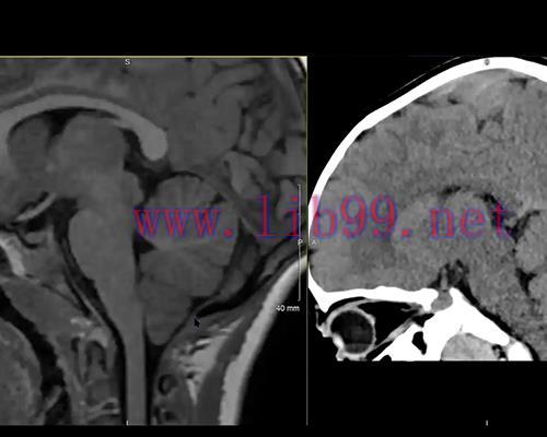 [AME]MRIOnline MRI Mastery Series: Infratentorial/Posterior Fossa Defects 2021 (CME VIDEOS)