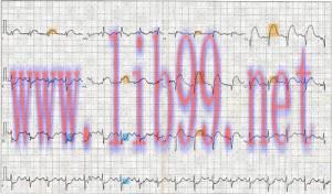 [AME]Physician Assistant Care Series &ndash; 12 Lead EKG Review (EPUB)